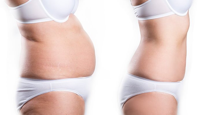 Liposuction